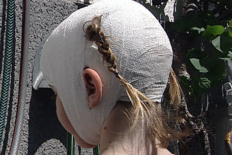 Vierjährige Amelie mit Kopfverband nach Hundeattacke