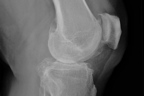 Röntgenbild von einem kranken Knie