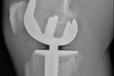 Röntgenbild von einem künstlichen Kniegelenk