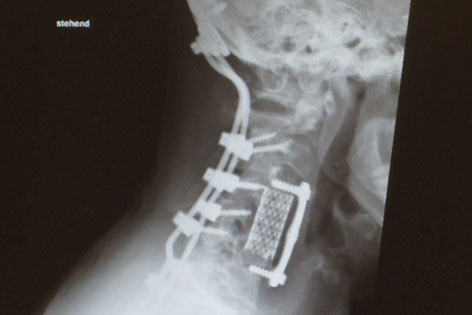 Röntgenbild einer Halswirbelsäule durch Schrauben fixiert