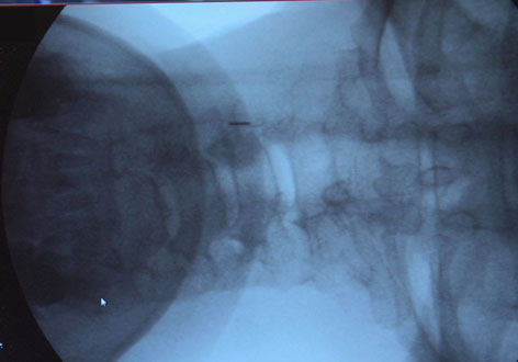 Röntgenbild mit Nadel