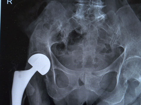Röntgenbild Oberschenkelhals-OP
