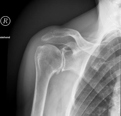 Röntgenbild einer Schulter