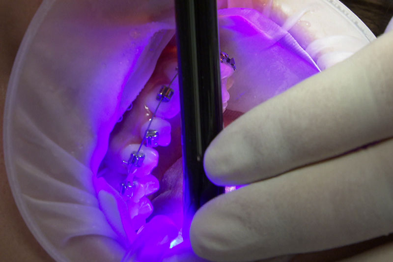 Kind bei Zahnspangenbehandlung beim Kieferorthopäden mit UV Licht